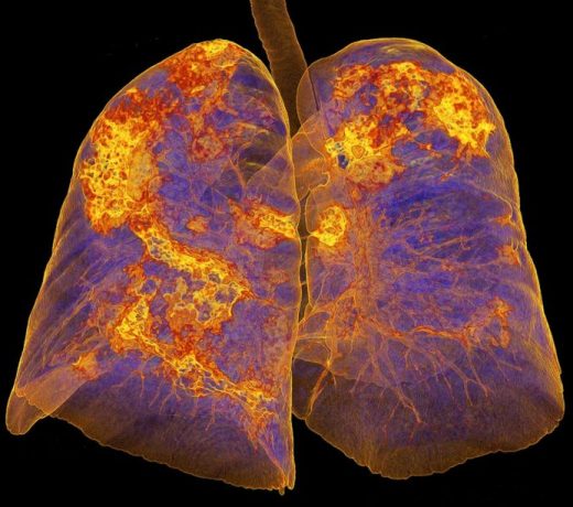 लांग कोविड : मरीज में क्या हैं लक्षण ?