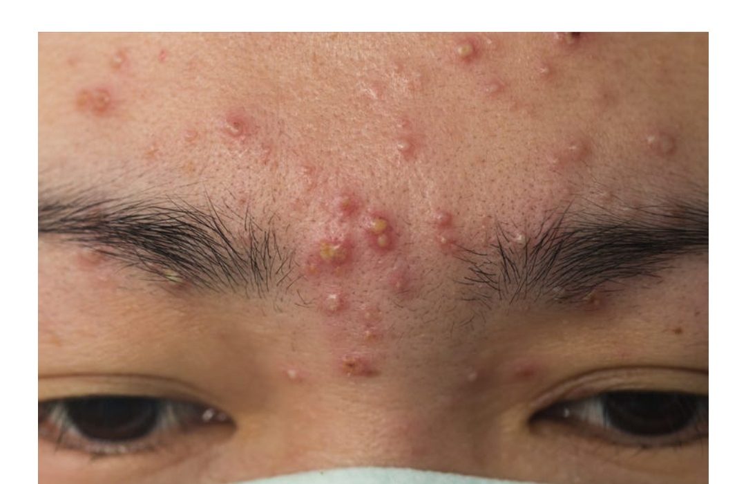 कील-मुंहासों के कारण और छुटकारा पाने के उपाय, ये करें जल्द मिलेगी राहत