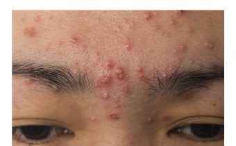 Causes of pimples and remedies to get rid, do this you will get relief soon