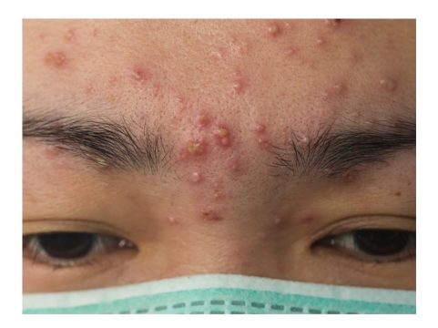 Causes of pimples and remedies to get rid, do this you will get relief soon