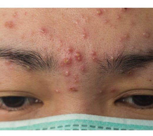 कील-मुंहासों के कारण और छुटकारा पाने के उपाय, ये करें जल्द मिलेगी राहत