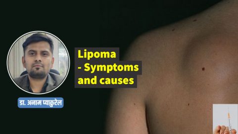 Lipoma - Symptoms and causes