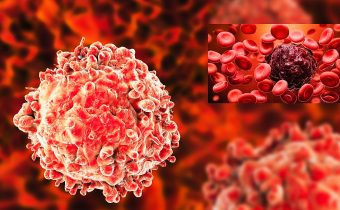 Leukemia : Types, Risk Factors, Signs and Symptoms and Prognosis