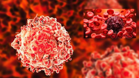 Leukemia : Types, Risk Factors, Signs and Symptoms and Prognosis