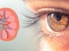 Don’t Ignore These 4 Eye Symptoms : They Could Be Warning Signs of Kidney Failure